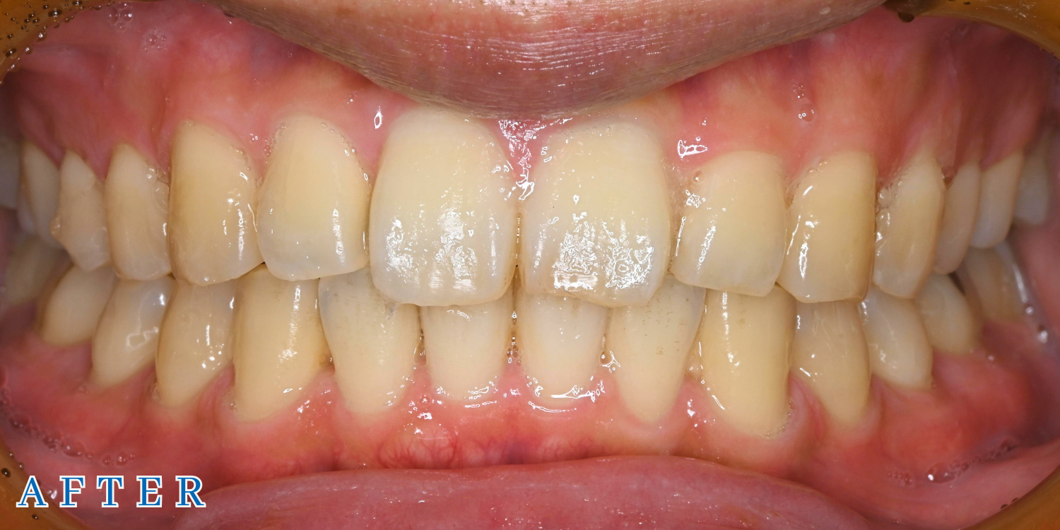 マウスピース型矯正「クリアコレクト」症例01（アフター）｜青山一丁目麻布歯科